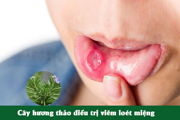 Bài thuốc cây hương thảo chữa viêm loét miệng, viêm tuyến nước bọt.