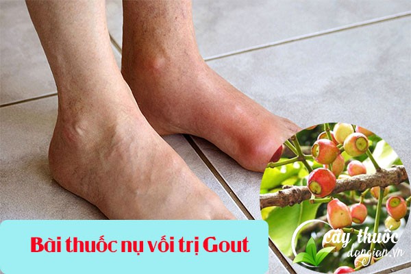 Bài thuốc nụ vối chữa bệnh Gout hiệu quả